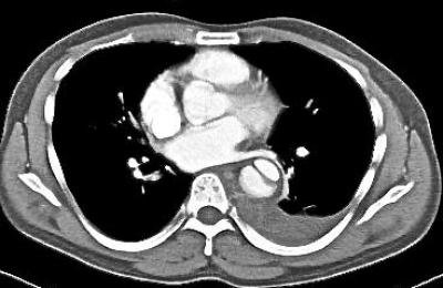 Figure 1a: Contrast enhanced CT angiogram of the thorax reveals an intimal flap within the descending aorta giving rise to a true and false lumen.